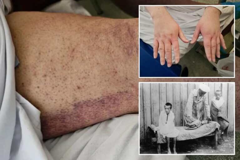 The ancient disease of scurvy is making a shocking comeback - here's why

