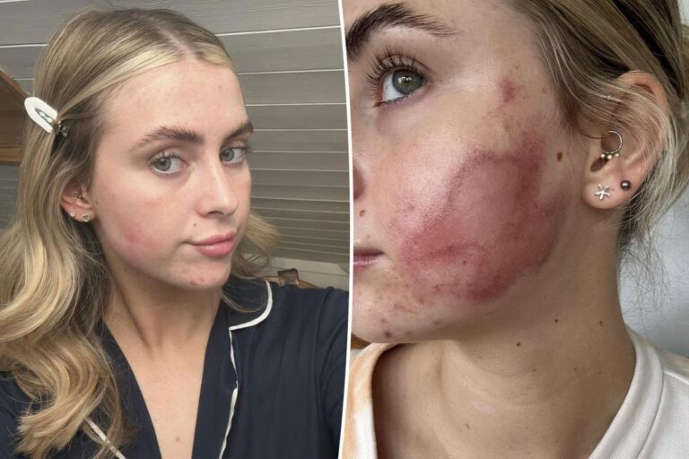 Woman left with second-degree burns, scars after routine beauty procedure: 'I wanted to feel safe'

